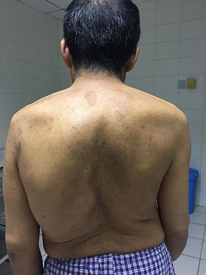 Case Report: Multi-Orifices Vertebral Arteriovenous Fistula With Severe Scoliosis in Neurofibromatosis Type 1: Might Be a Congenital Disease With Mesodermal Dysplasia